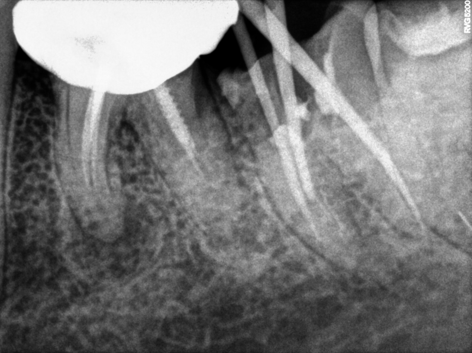 Dental X-ray